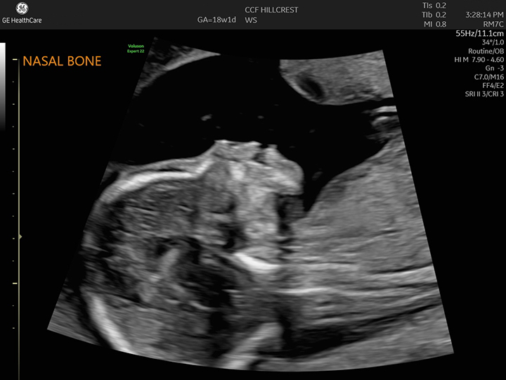 20-week ultrasound scan